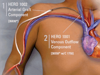 Image: The Hemodialysis Reliable Outflow (HeRO) graft system (Photo courtesy of CryoLife).